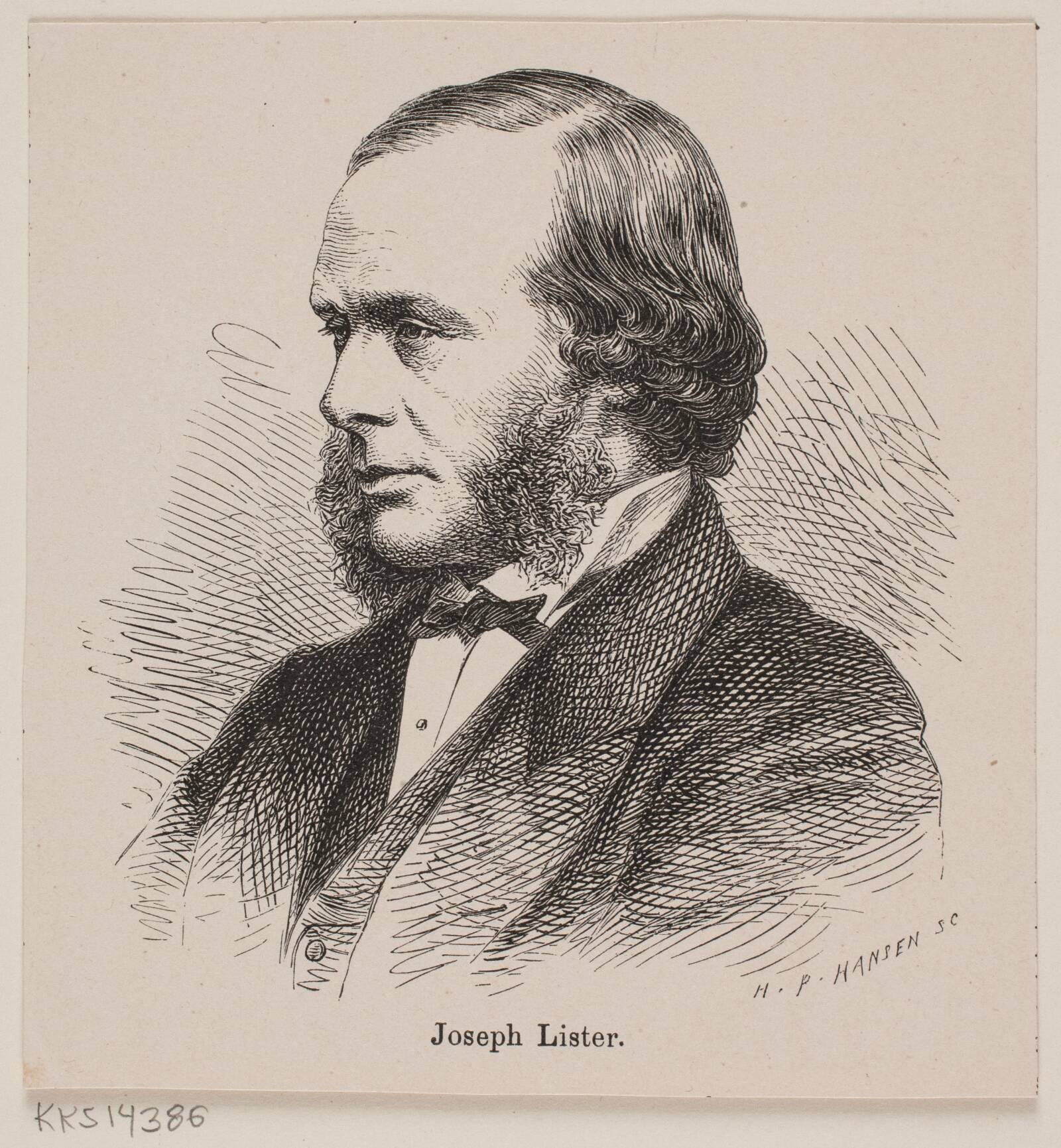Joseph Lister, H.P. Hansen, 1876